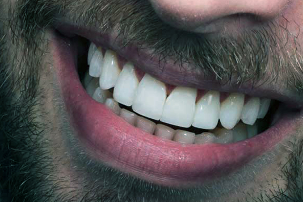 تجميل الأسنان في سوريا, تكلفة تجميل الأسنان في سوريا, أفضل أطباء تجميل الأسنان في سوريا, زراعة الأسنان في سوريا, تبييض الأسنان في سوريا, تركيب الفينير في سوريا, تقنيات تجميل الأسنان في سوريا, أسعار زراعة الأسنان في سوريا, مراكز تجميل الأسنان في سوريا, تقويم الأسنان في سوريا, أحدث تقنيات تجميل الأسنان في سوريا, تجميل الأسنان بأقل تكلفة, خدمات تجميل الأسنان في سوريا , تجميل الأسنان, زراعة الأسنان, تبييض الأسنان, تركيب الفينير, تقويم الأسنان, أطباء الأسنان, مراكز تجميل الأسنان, سوريا, تكلفة تجميل الأسنان, تجميل الأسنان سوريا