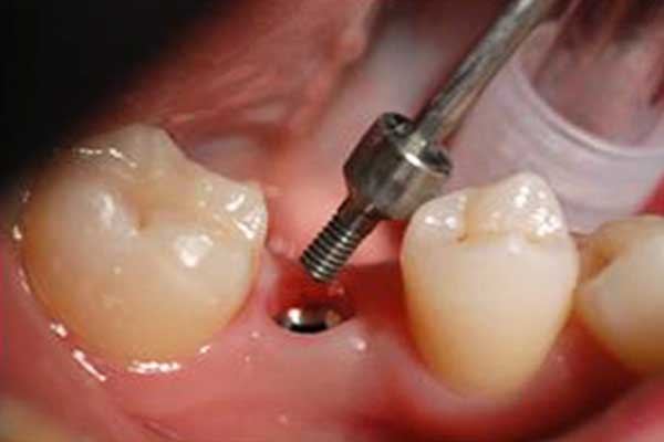 مخاطر زراعة الأسنان, أضرار زراعة الأسنان, سلبيات زراعة الأسنان, مشاكل زراعة الأسنان, زراعة الأسنان الفورية, زراعة الأسنان التقليدية, زراعة الأسنان المصغرة, التهاب اللثة بعد زراعة الأسنان, فشل زراعة الأسنان, تكاليف زراعة الأسنان, فوائد زراعة الأسنان, مضاعفات زراعة الأسنان, تجارب زراعة الأسنان, نصائح بعد زراعة الأسنان