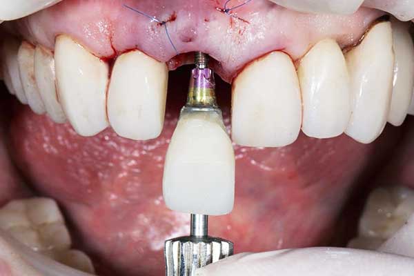 زراعة الأسنان, فوائد زراعة الأسنان, تكلفة زراعة الأسنان, زراعة الأسنان الفورية, زراعة الأسنان التقليدية, تقنيات زراعة الأسنان, زراعة الأسنان في السعودية, زراعة الأسنان في تركيا, أفضل طبيب زراعة أسنان, العناية بزراعة الأسنان