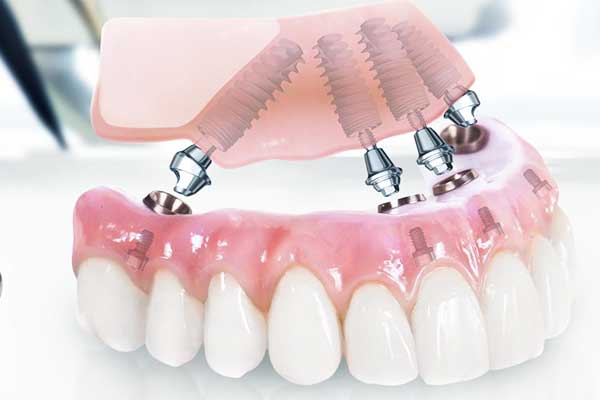 زراعة الأسنان في سوريا, نسبة نجاح زراعة الأسنان, تكلفة زراعة الأسنان, تقنيات زراعة الأسنان, زراعة الأسنان بالليزر, زراعة الأسنان الفورية, زراعة الأسنان التقليدية, أفضل أطباء زراعة الأسنان في سوريا, أسعار زراعة الأسنان في سوريا, زراعة الأسنان في دمشق, مراكز زراعة الأسنان في سوريا, نسبة نجاح زراعة الأسنان عالمياً, الفرق بين زراعة الأسنان التقليدية والفورية, العناية بزراعة الأسنان, مدة نجاح زراعة الأسنان, مخاطر زراعة الأسنان, فوائد زراعة الأسنان, زراعة الأسنان والتجميل