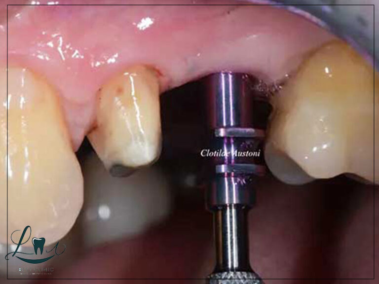 Bone Grafting Explained