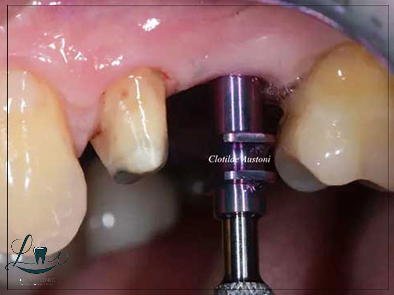 Bone Grafting Explained