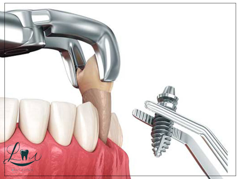 Cost of Dental Implants in Turkey