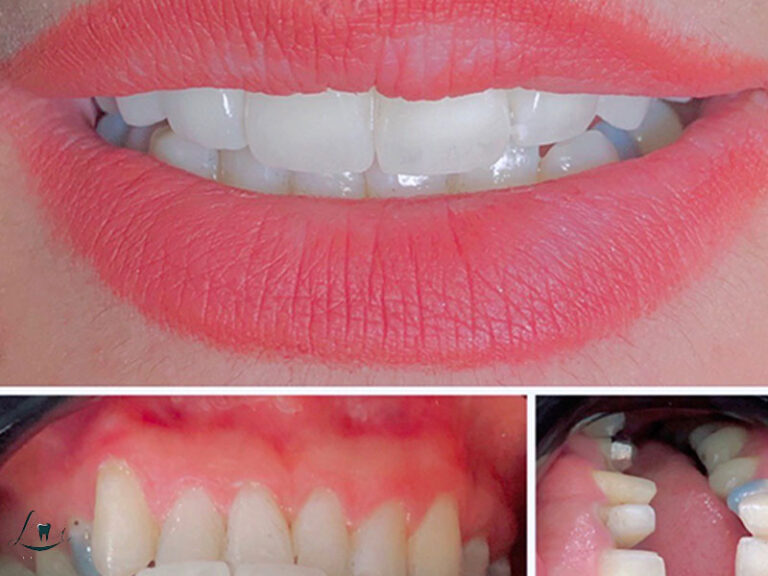 How Many Days for Dental Treatment in Turkey