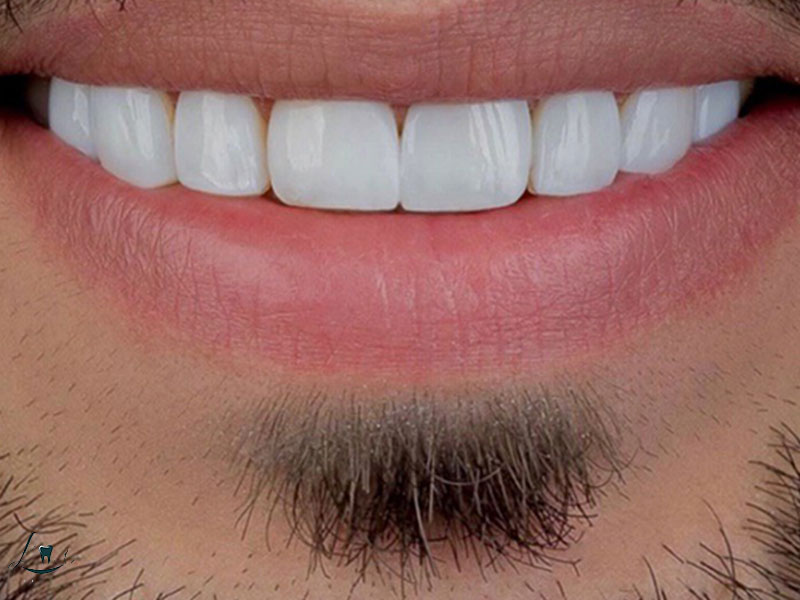 Is Dental Treatment in Turkey Safe