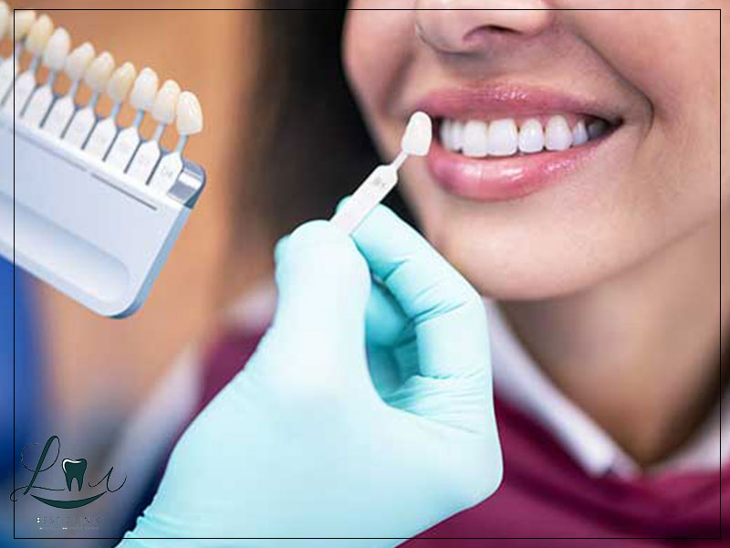 Dental veneers before and after