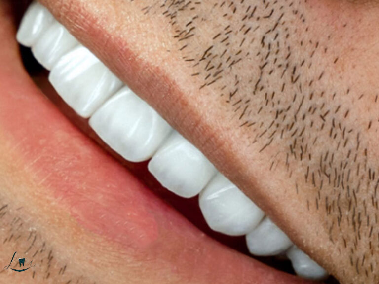 Why Turkey Is Cheap for Dental Implants