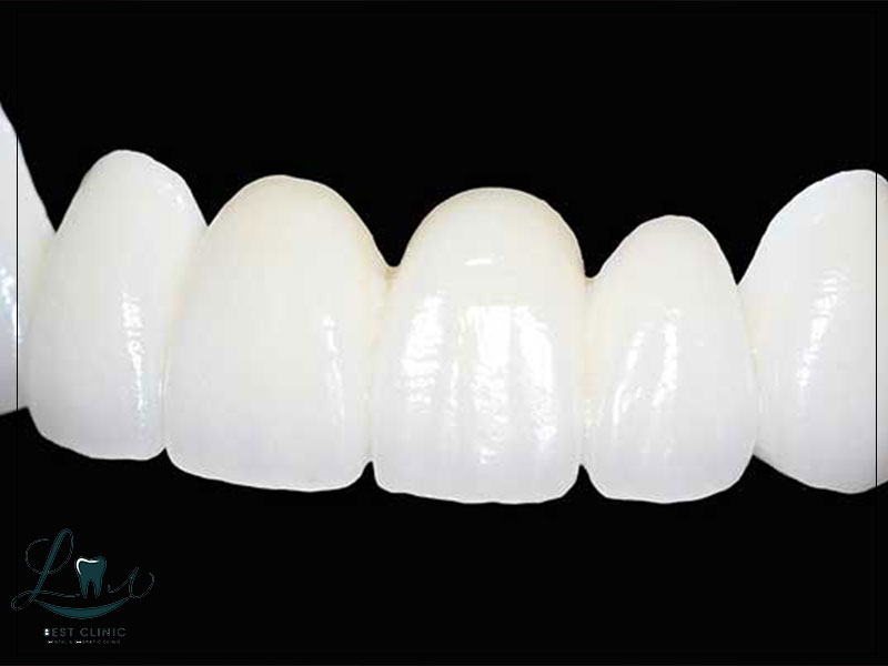 Zirconium vs Emax Veneers