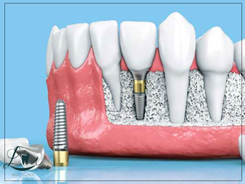 are dental implants painful