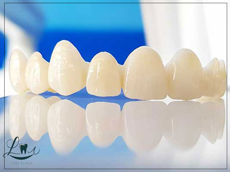 are veneers permanent