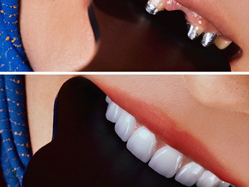 before after dental tourism stories