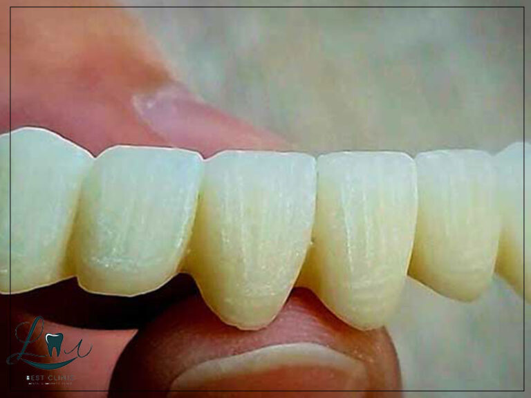 best age for veneers