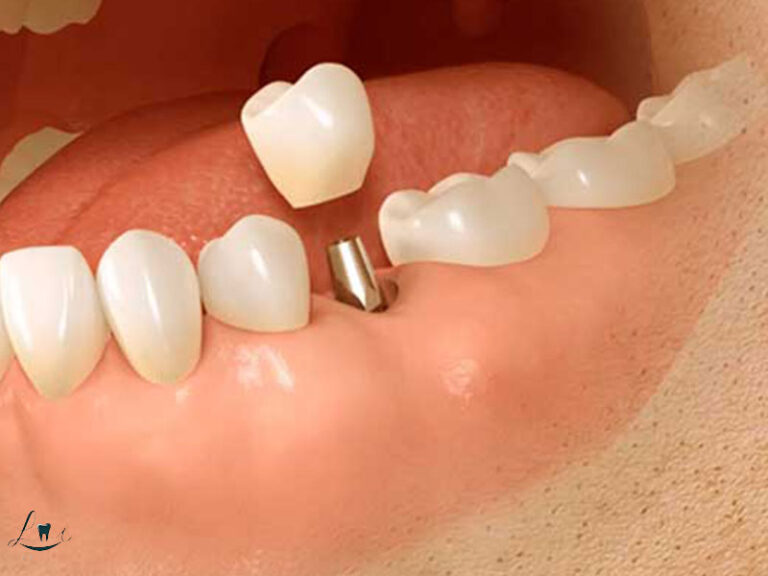 complications of implants