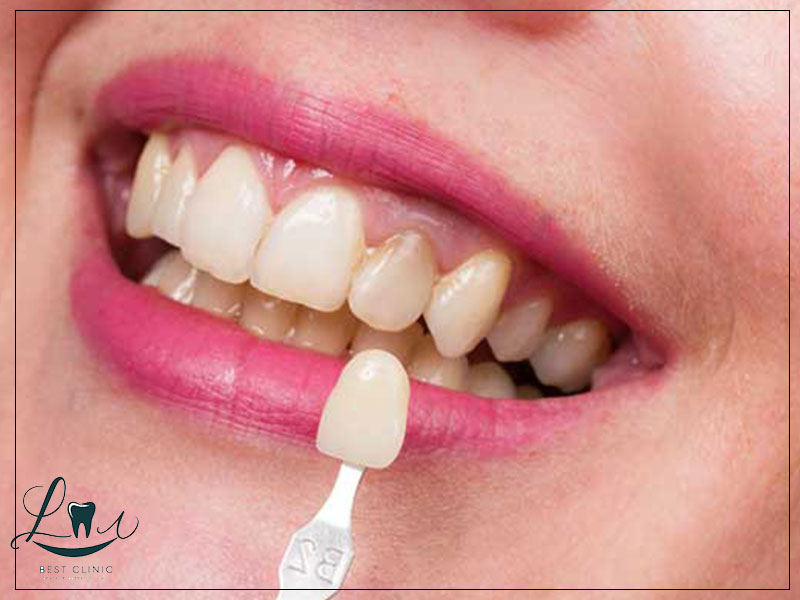 composite vs porcelain veneers