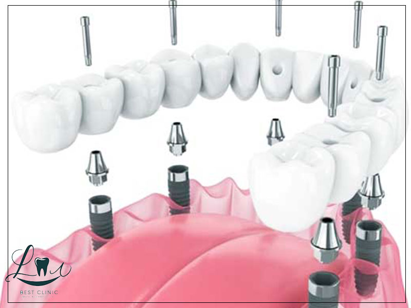 dental implant healing process