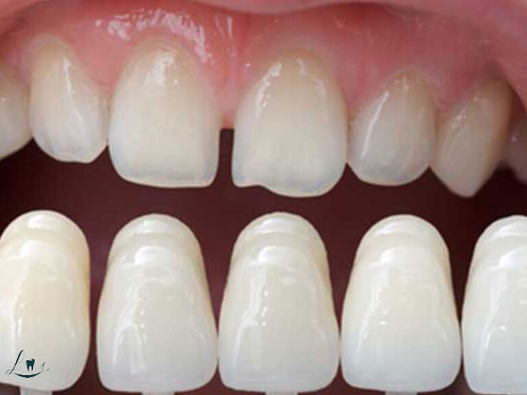 digital smile design process