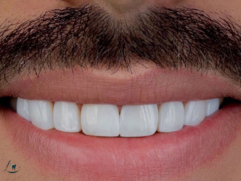 failed dental implants causes
