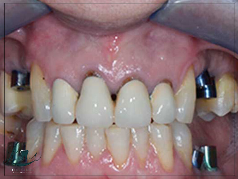 full mouth dental implants procedure
