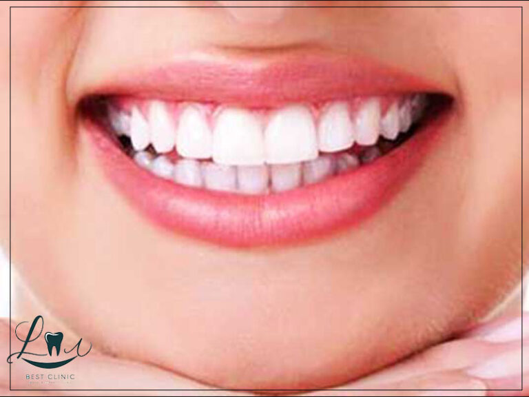 hollywood smile procedure explained