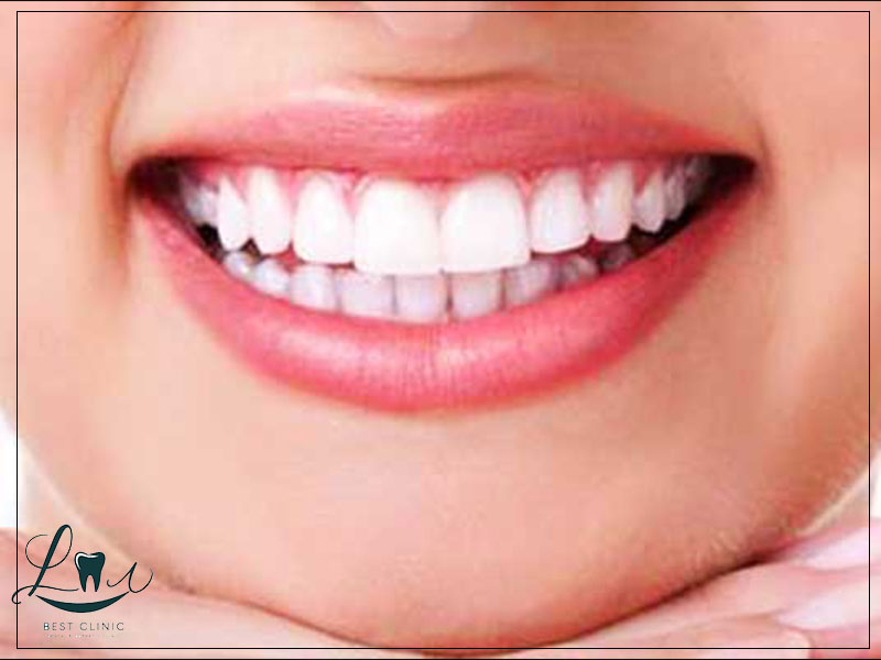 hollywood smile procedure explained
