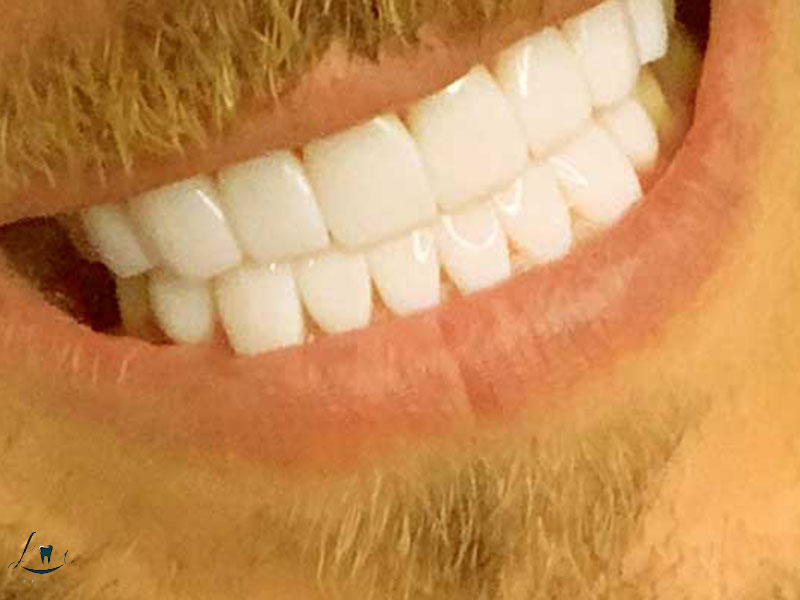 hollywood smile vs veneers