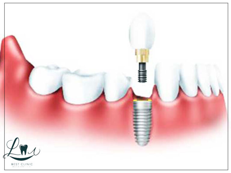 how long do dental implants last