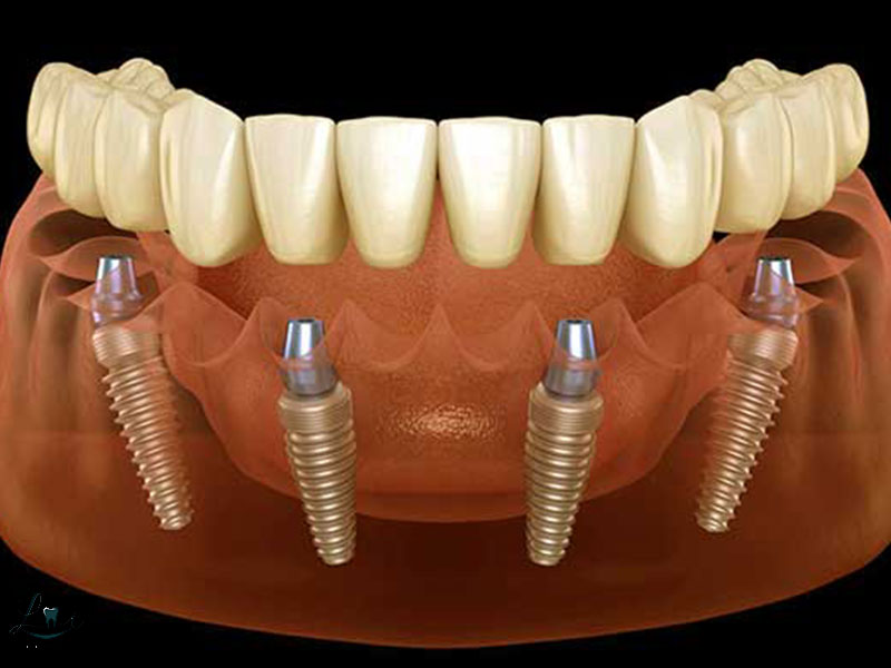 how to prepare for dental implants