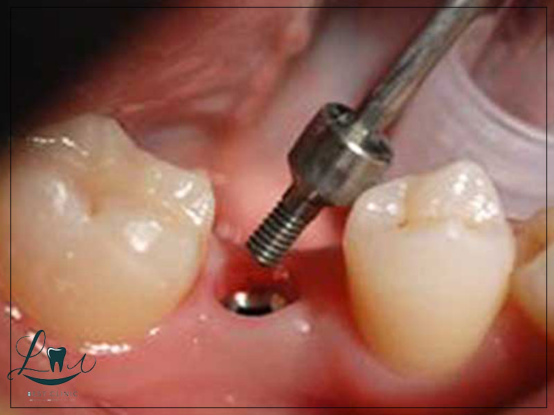 immediate vs delayed implants