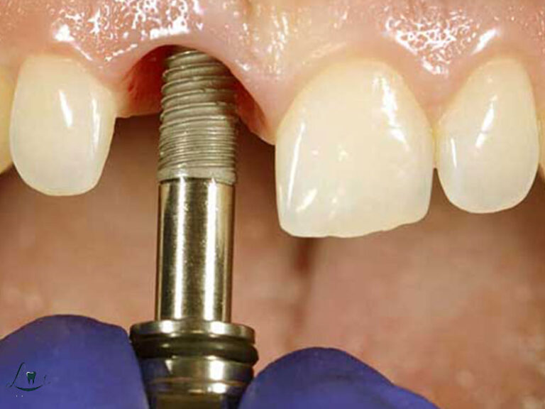infection after dental implants