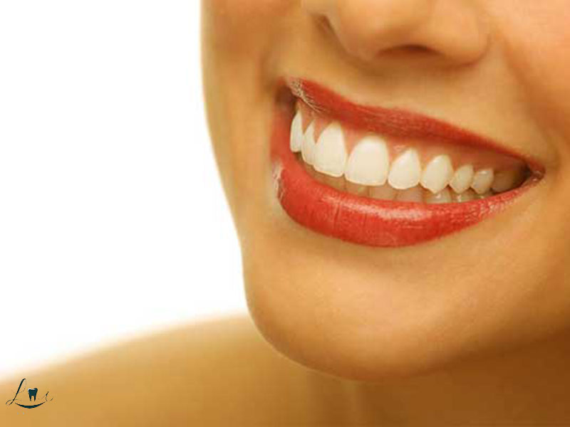 recovery after veneers