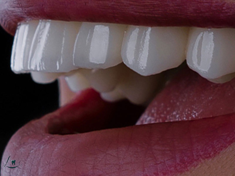 signs of bad veneers