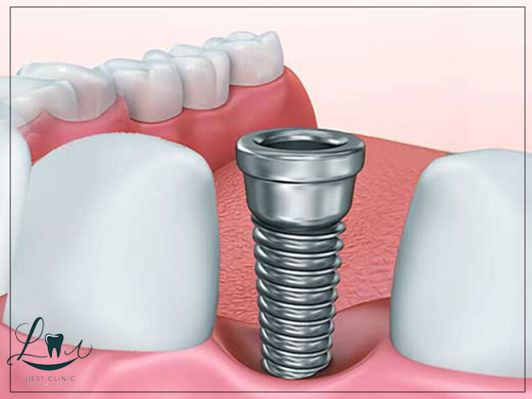 single tooth implant cost guide