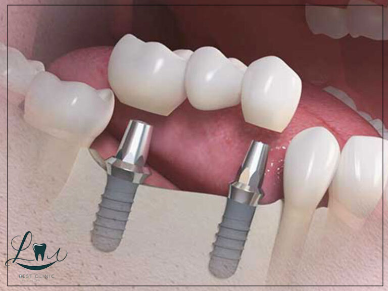 sinus lift procedure guide
