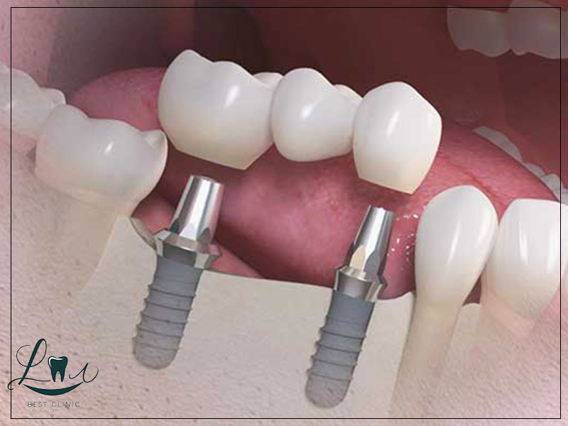 sinus lift procedure guide