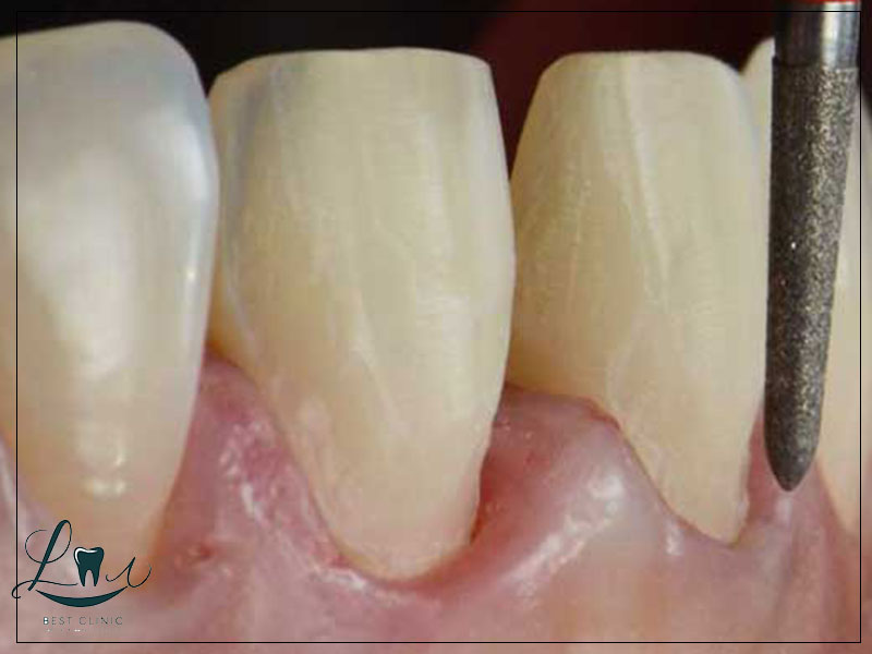 teeth shaving for veneers risks