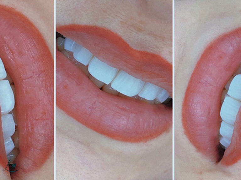 turkey teeth gone wrong explained