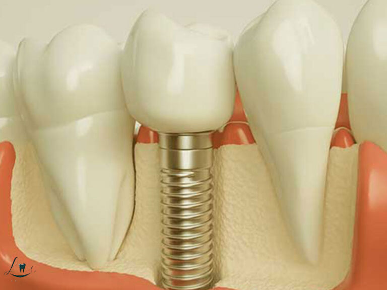 what to eat after implants
